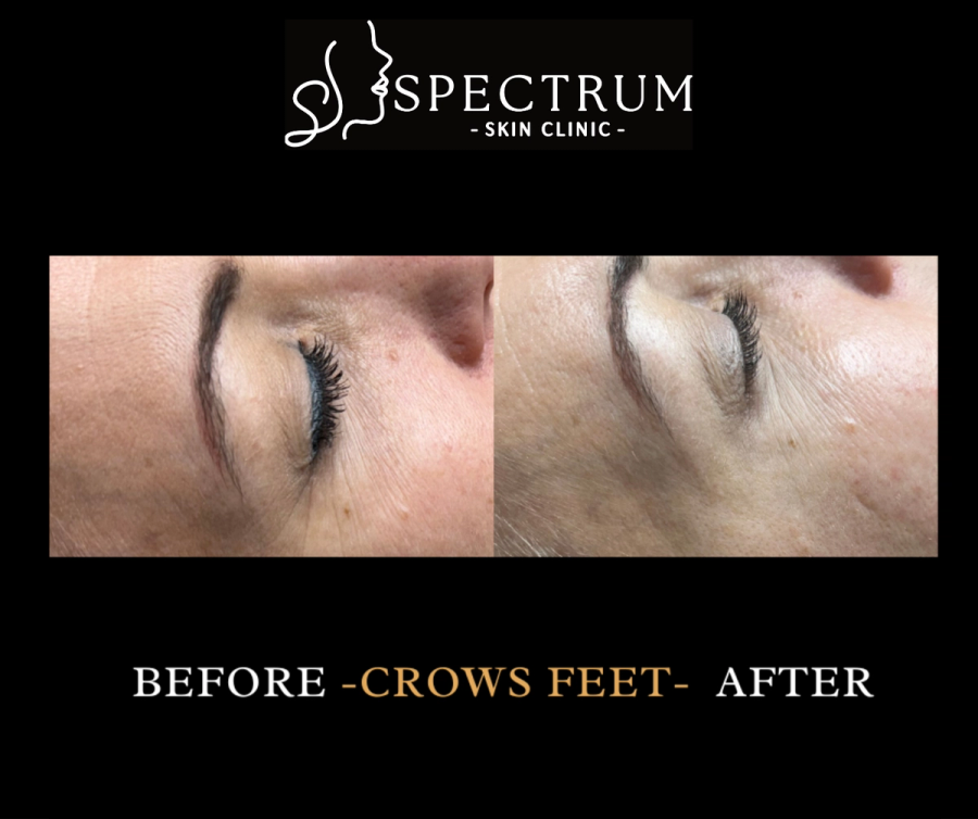 Botox Before & After | Crow's Feet Smoothing in Orange County, CA