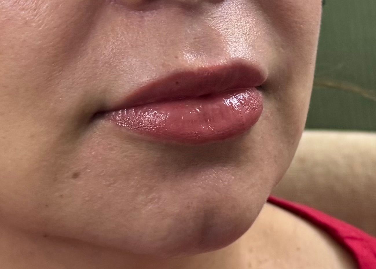 Lip Filler after — Perioral Volume, Lip Shape, front view