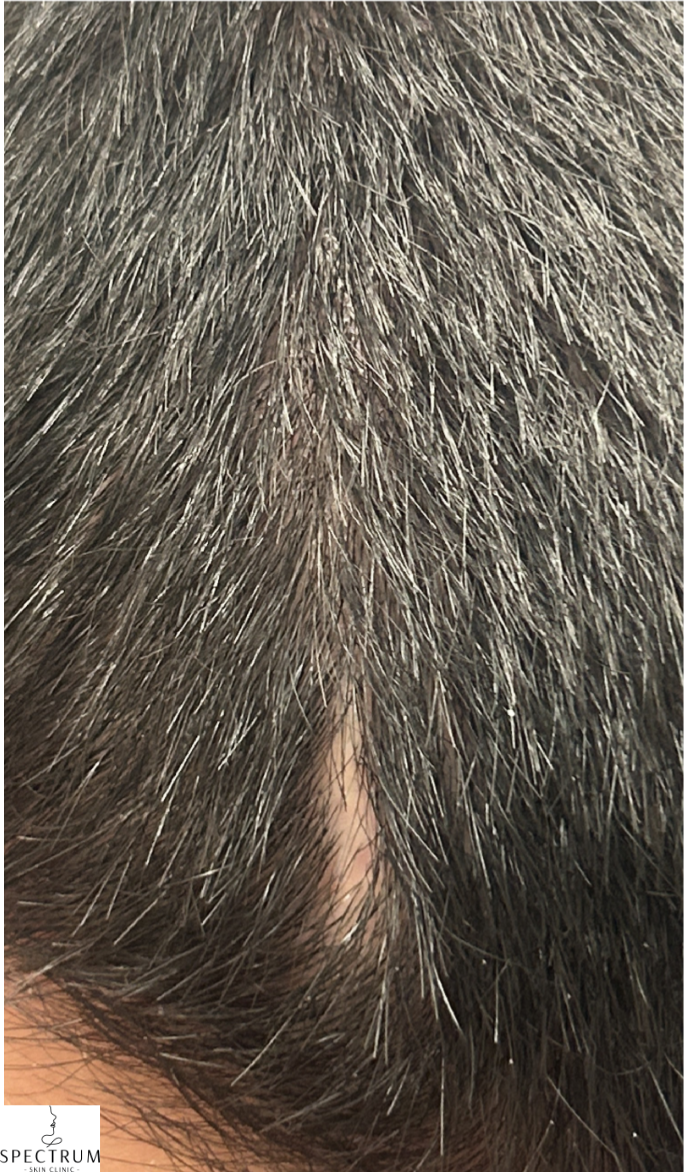 Exosome Therapy after — Hair Thinning, Part Line Thinning, front view