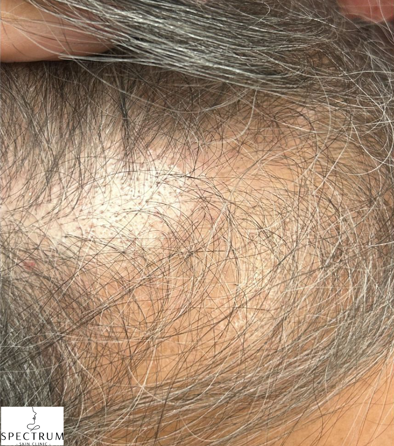 Exosome Therapy after — Post-Menopausal Hair Thinning, Crown Density Loss, front view
