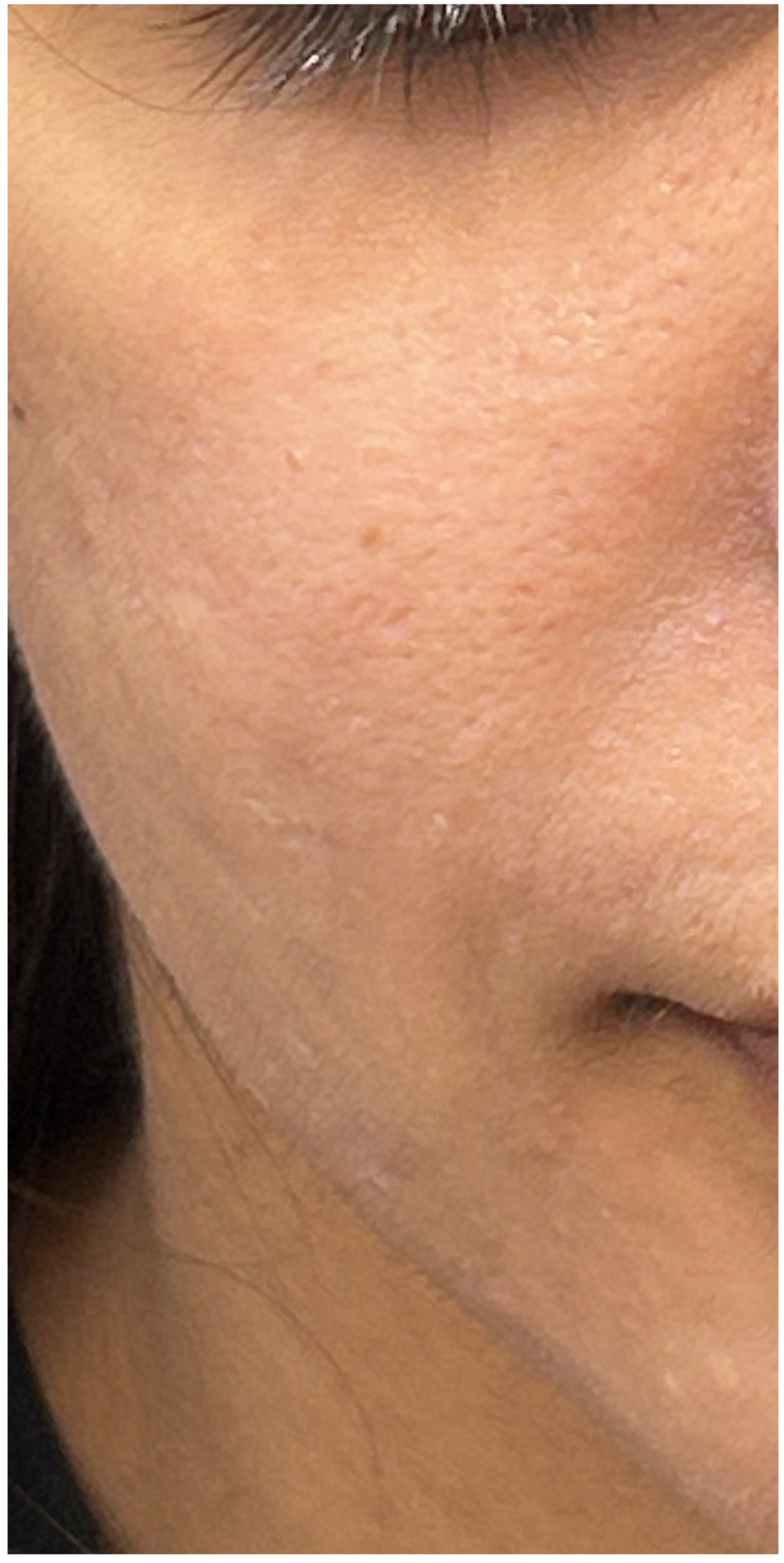 Secret PRO, TCA CROSS Peel after — Acne Scars, Uneven Texture, Hyperpigmentation, front view