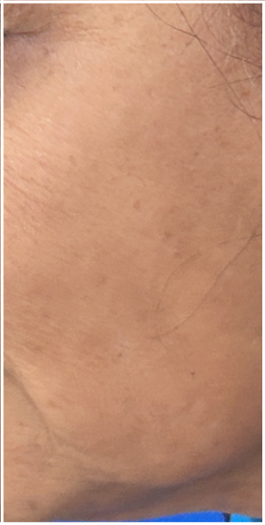 Pico Laser after — Hyperpigmentation, Sun Damage, Brown Spots, Solar Lentigines, front view