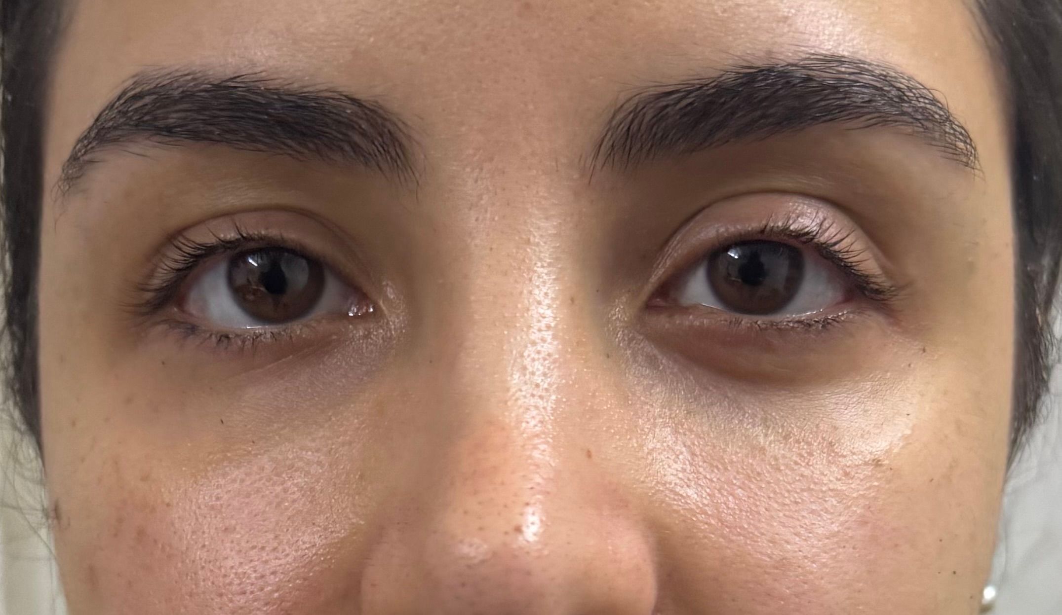 Under Eye Filler after — Under Eye Hollows, Dark Circles, Tear Trough, front view