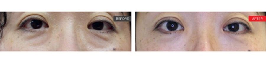 SmoothEye Laser Under-Eye Before and After