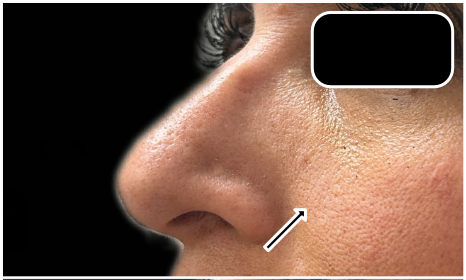 Under Eye Filler Dissolve before — Under Eye Hollows, Filler Migration, Tear Trough Migration, front view