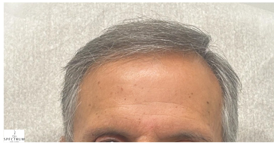 Exosome Therapy before — Male Frontal Hair Thinning, Hairline Density Loss, Mature Hair Loss, front view