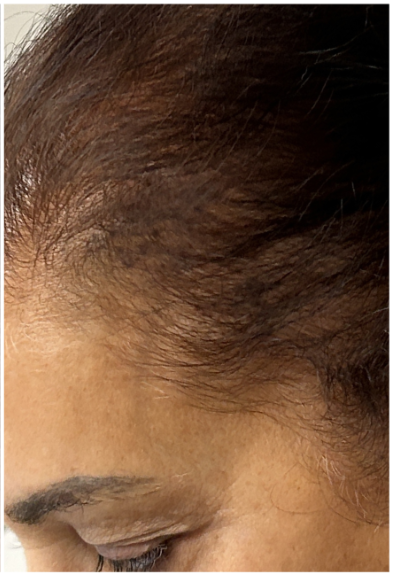 Exosome Therapy after — Hair Thinning at Temples Female, Temporal Hairline Thinning, front view
