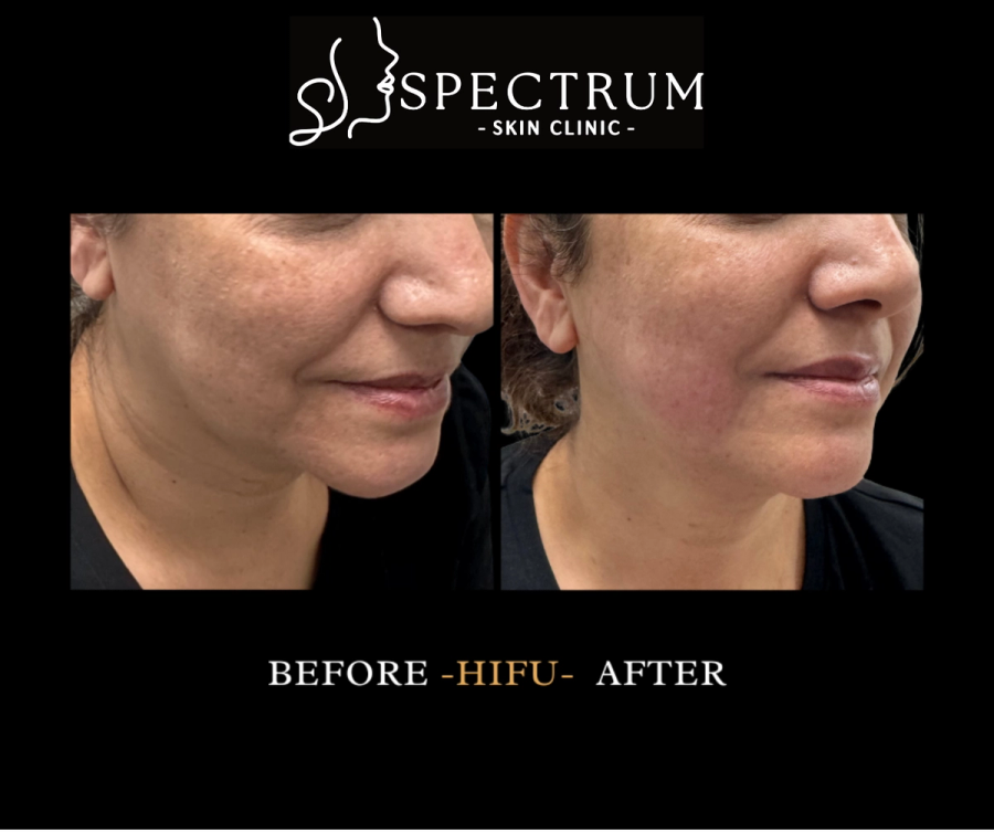 HIFU Before & After, Jawline Lift and Skin Tightening at Spectrum Skin Clinic, Irvine