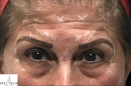 jeuveau after — Frown lines, forehead lines, brow tension, front view