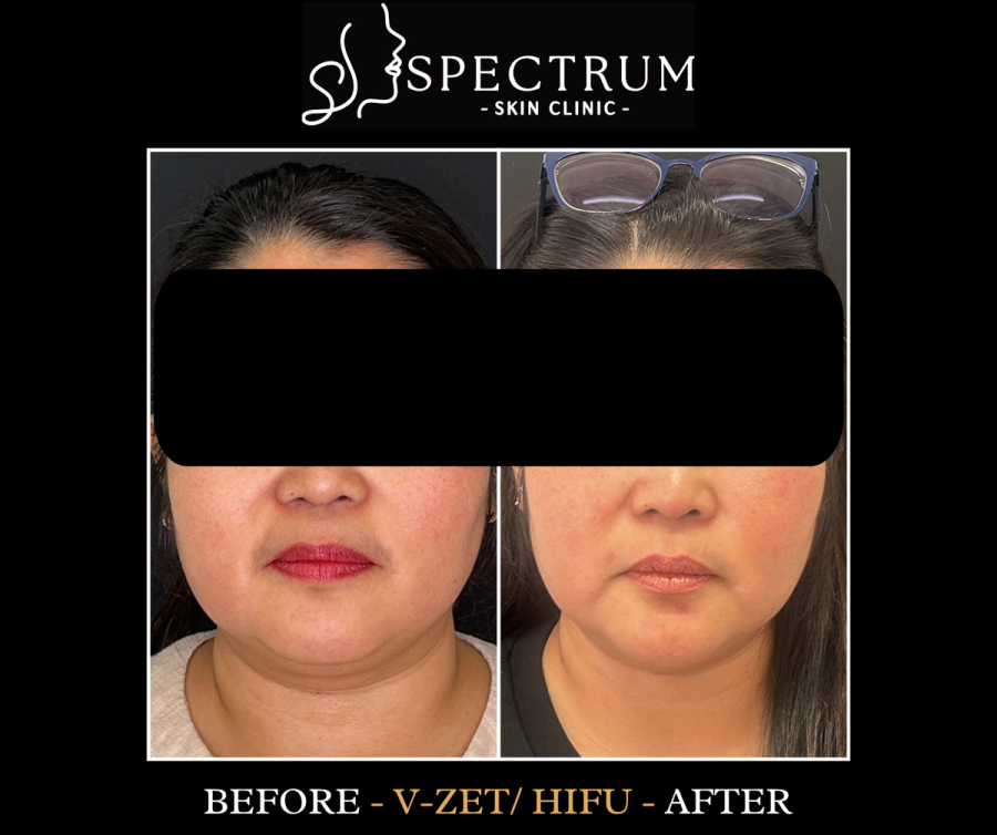 HIFU Before & After, Non-Surgical Skin Tightening at Spectrum Skin Clinic, Irvine