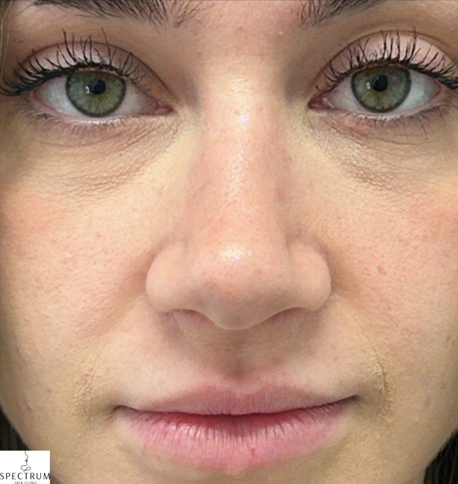Lip Filler before — Lip definition, volume asymmetry, and mild dehydration, front view