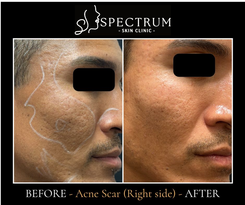Acne Scar Before & After | Texture and Tone, Front View