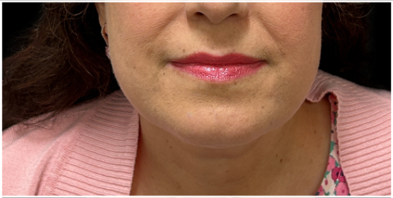 Kybella before — Double Chin, Submental Fullness, Submental Fat, front view