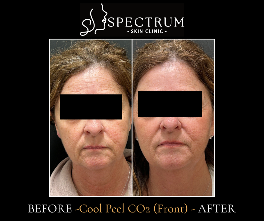 Cool Peel CO2 Before & After | Skin Tone and Texture Renewal (Front View)