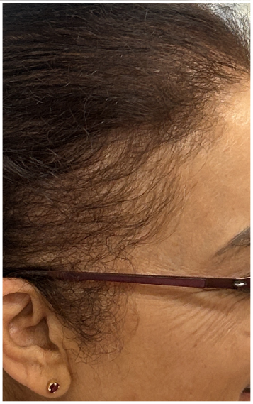 PRFM Hair Restoration before — Temporal Recession, Receding Hairline, Reduced Density at Temples, front view