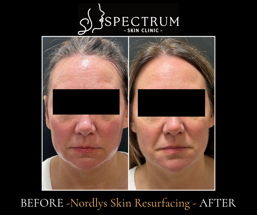 Nordlys Skin Resurfacing Before & After | Redness and Skin Tone Renewal