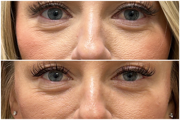 Under Eye Filler Dissolve, PRFM Under Eye after — Under Eye Hollows, Filler Migration, Crepey Eyelid Skin, Skin Quality, front view