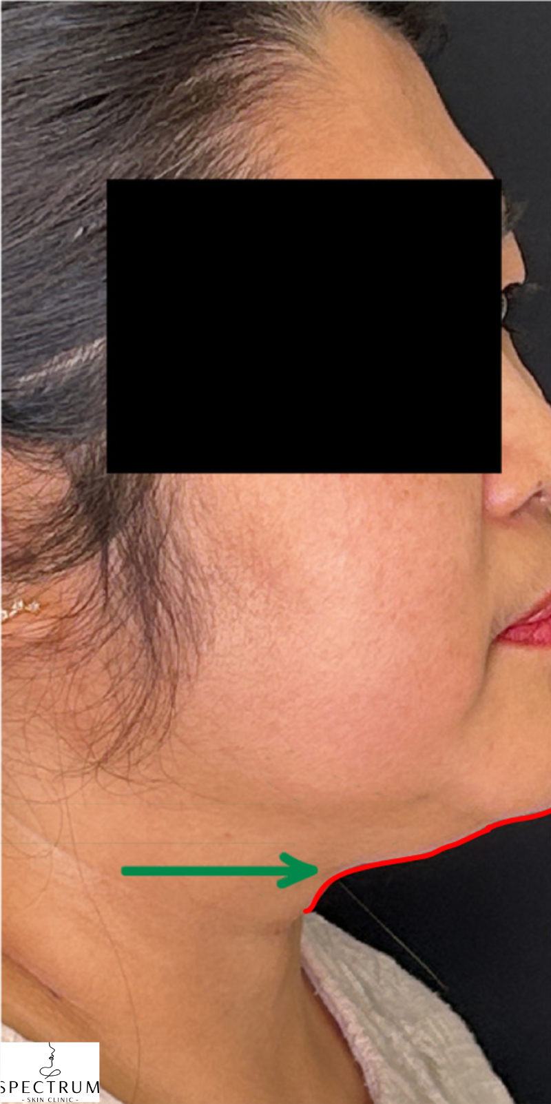 HIFU before — Double Chin, Submental Fullness, Sagging and Laxity, front view