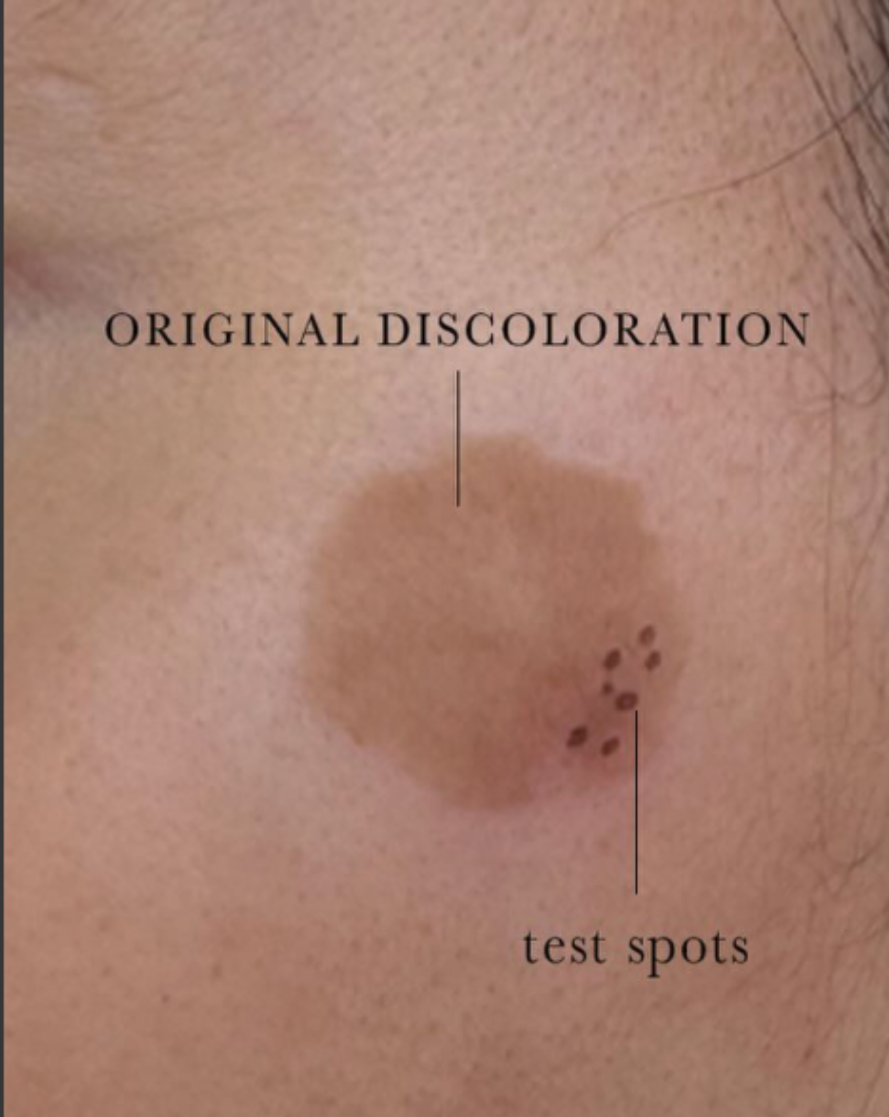 Q-Switch ND:YAG Laser for Sun Spots before — Sun Spots, Hyperpigmentation, Photodamage, front view