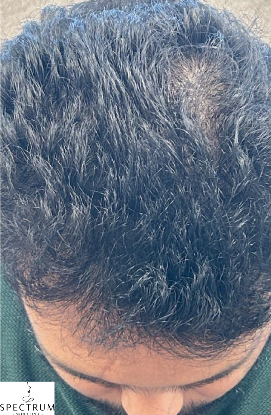 Exosome Therapy before — Thinning Crown, Visible Scalp, front view