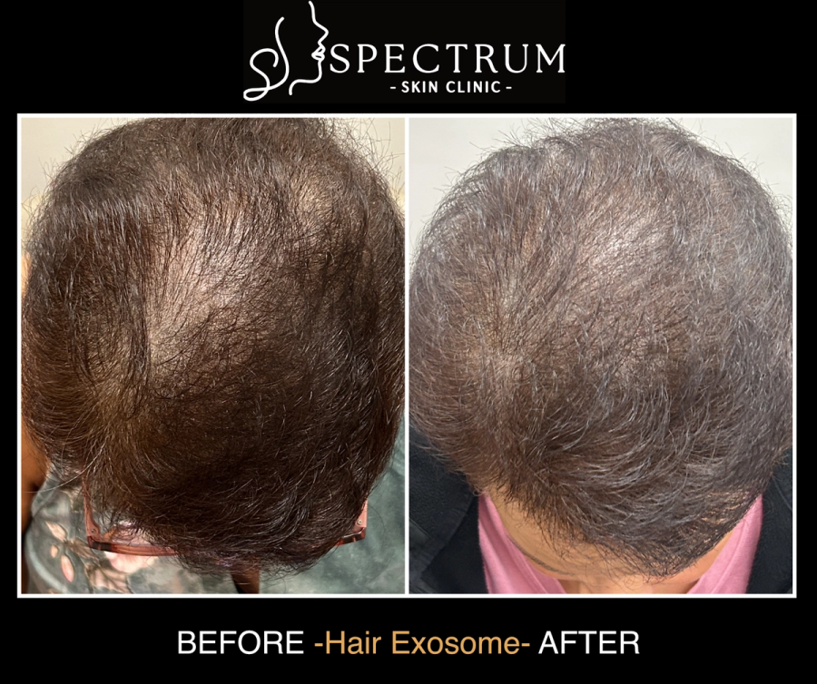 Exosome Therapy Before and After, Hair Loss Response to First Series at Spectrum Skin Clinic, Irvine