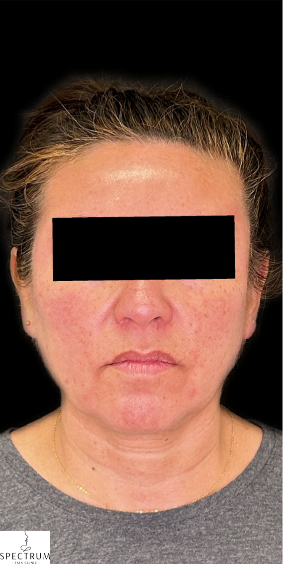 Sculptra before — Midface Volume Loss, Sagging and Laxity, Collagen Loss, Hollow Cheeks, front view