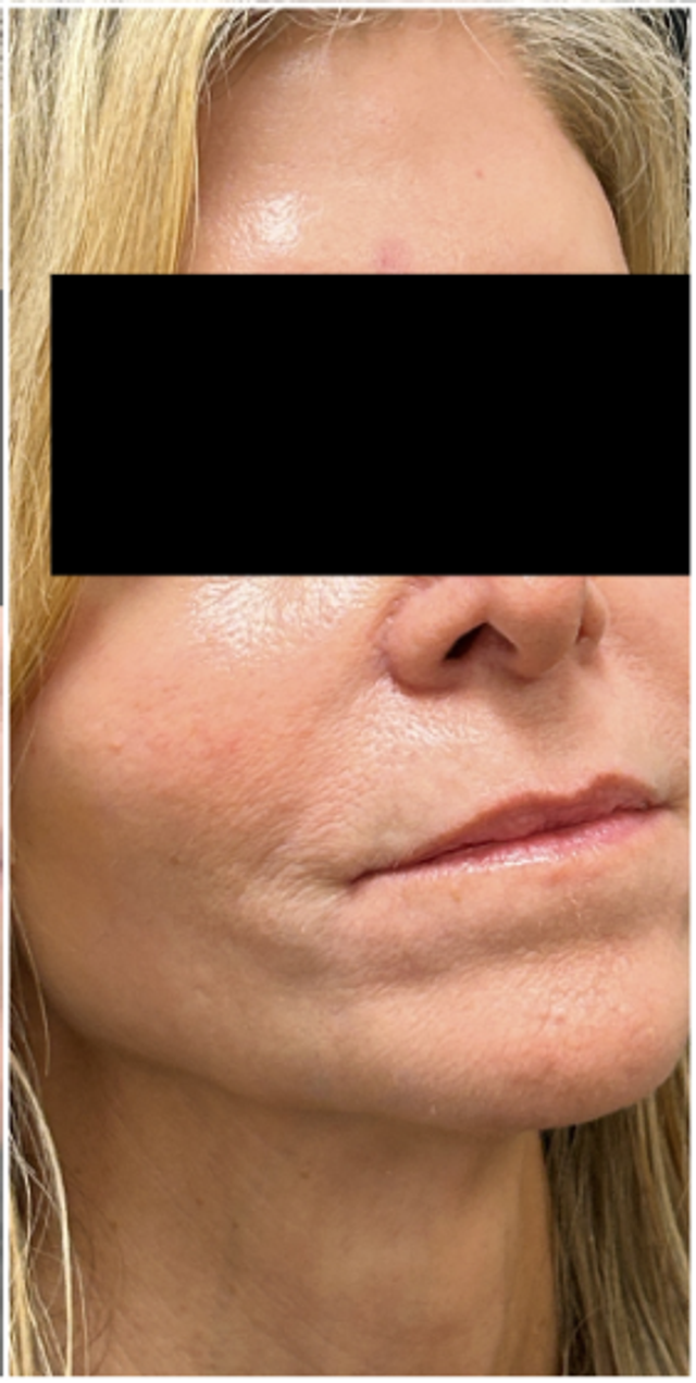 CO2 Laser Before & After | Perioral Lines and Skin Texture (Oblique View) — after
