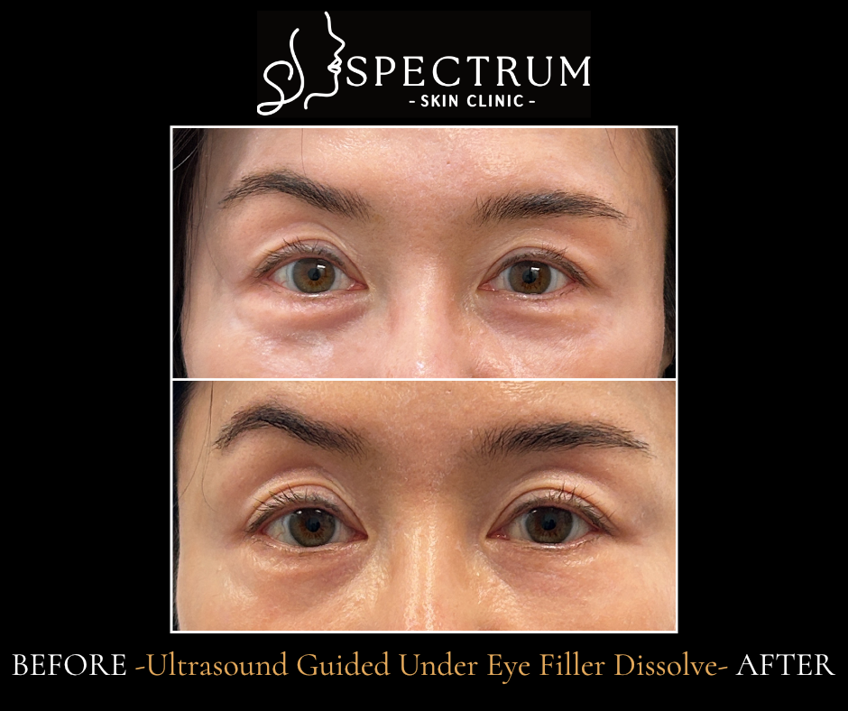 Ultrasound-Guided Under Eye Filler Dissolve Before & After | Precise Periorbital Correction