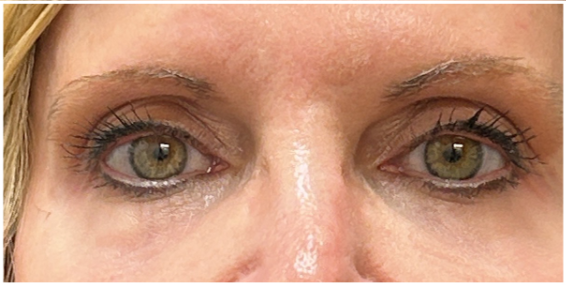 eMatrix Sublative RF, Rejuran before — Periorbital Fine Lines, Under-Eye Texture, Crepey Eyelid Skin, Dullness, front view