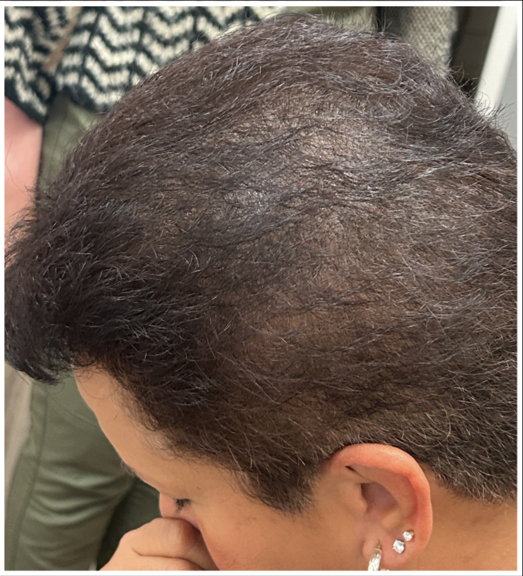 Exosome Hair Therapy after — Crown Thinning, Reduced Hair Density, Visible Scalp, front view