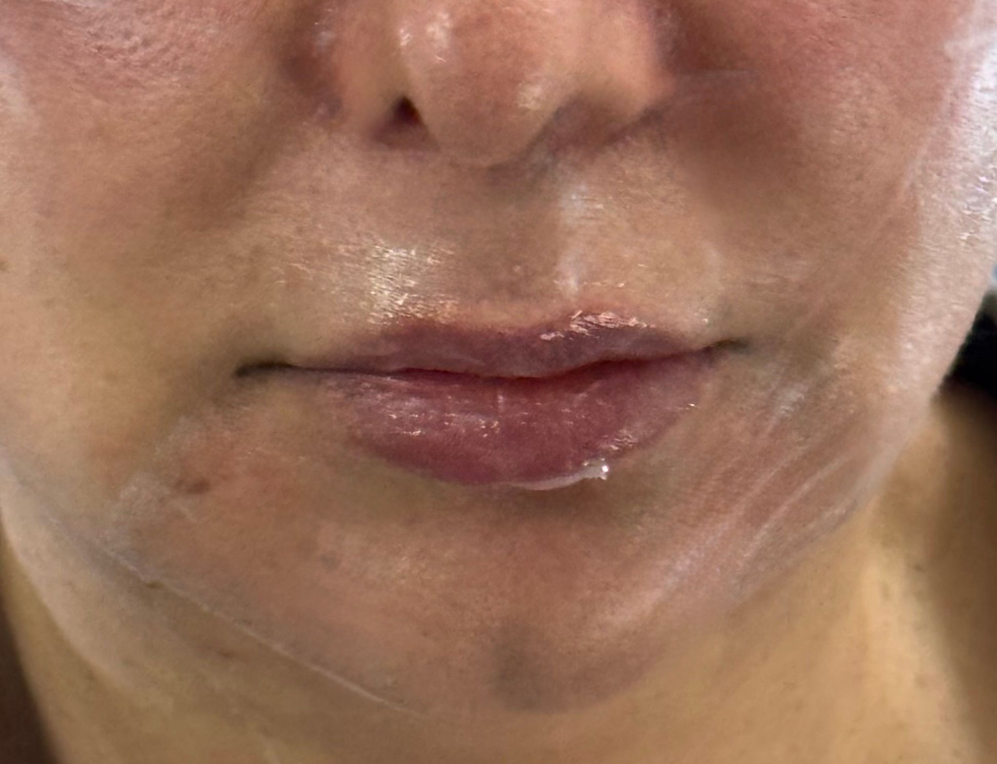Lip Filler before — Thin Lips, front view