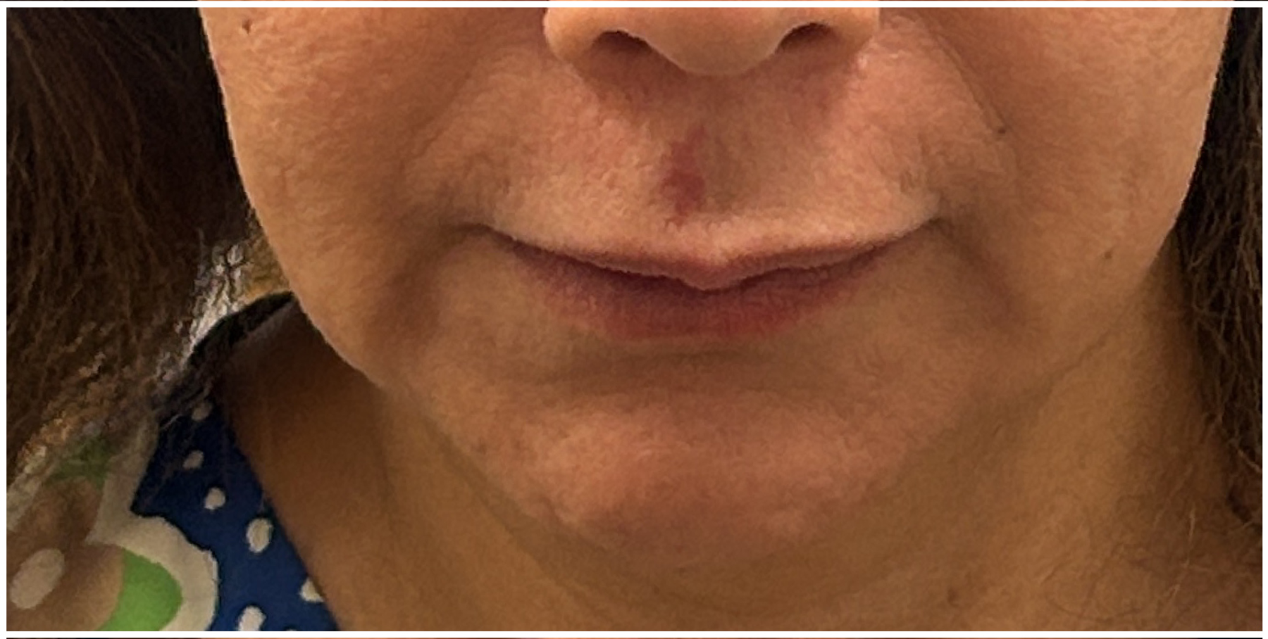 Chin Filler before — Marionette Lines, Weak Chin, Lower Face Definition, Sagging and Laxity, front view