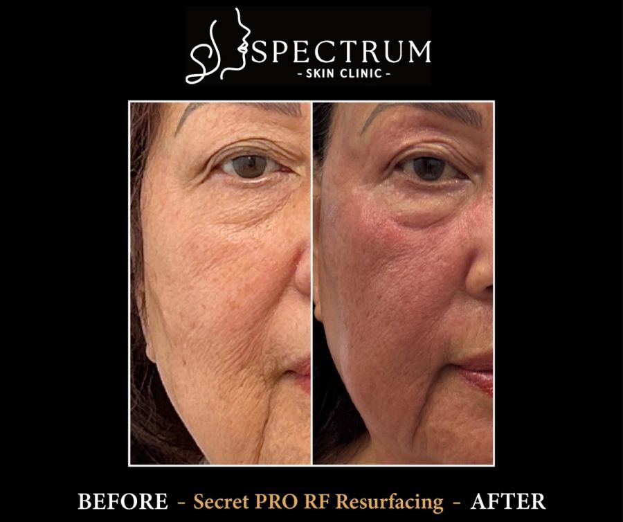 Resurfacing result showing texture and tone change. Treated at Spectrum on an RF resurfacing platform, shown here as an example of how texture change presents.