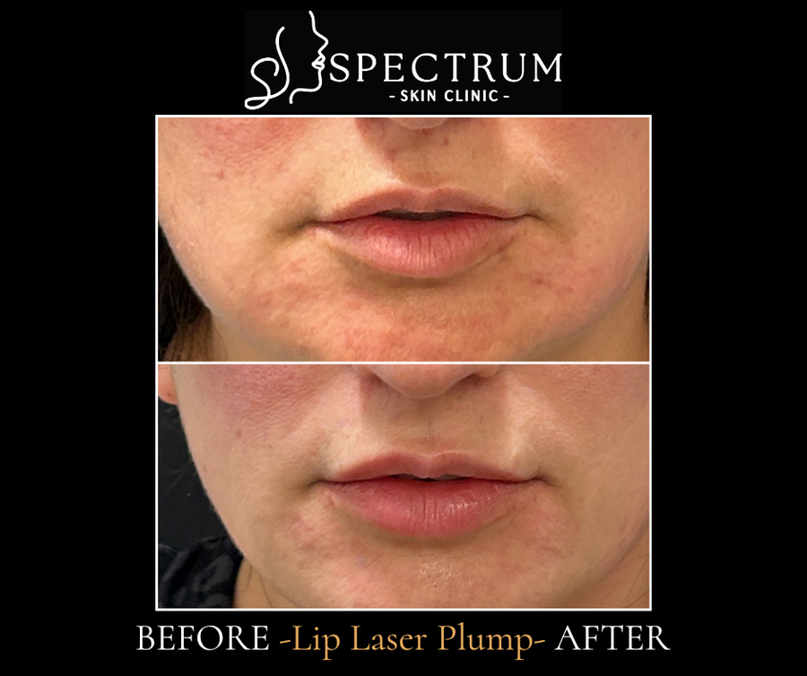 Lip Laser Plump Before and After | Needle-Free Laser Lip Volume Front View