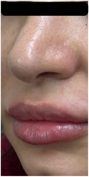 Lip Filler Dissolve after — Uneven Texture, Filler Migration, front view