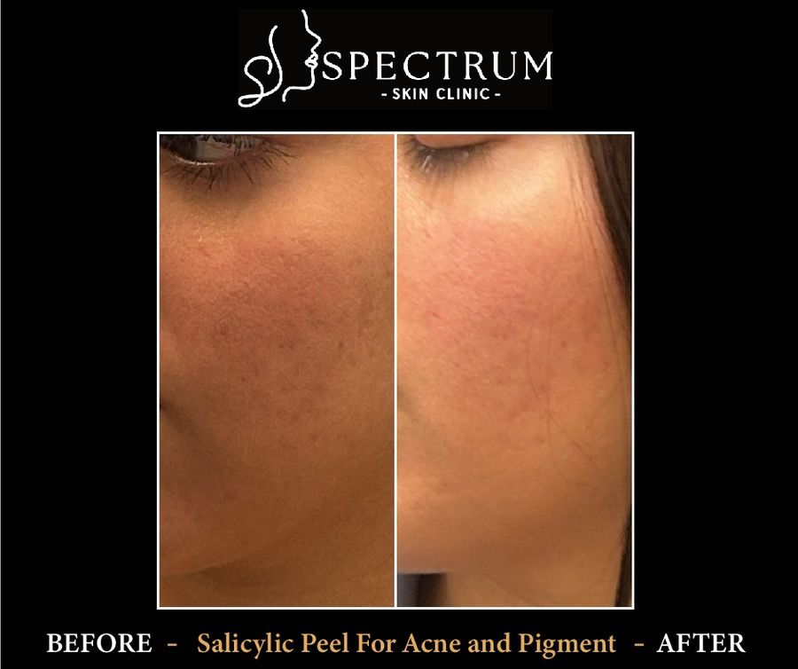 Acne and Pigment Correction Before & After | Salicylic Peel for Active Acne
