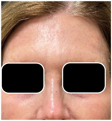 CO2 Laser Resurfacing before — Forehead Lines, Uneven Skin Texture, Sun Damage, Redness, front view