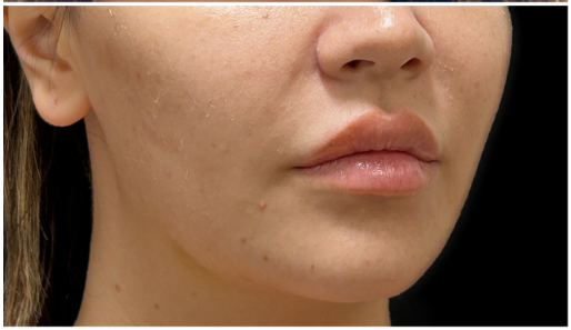 Masseter Botox after — Wide Jawline, front view