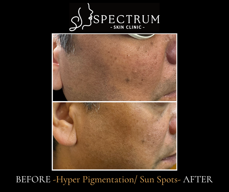 Hyperpigmentation and Sun Spot Treatment Before & After | Pico Laser in a Male Patient