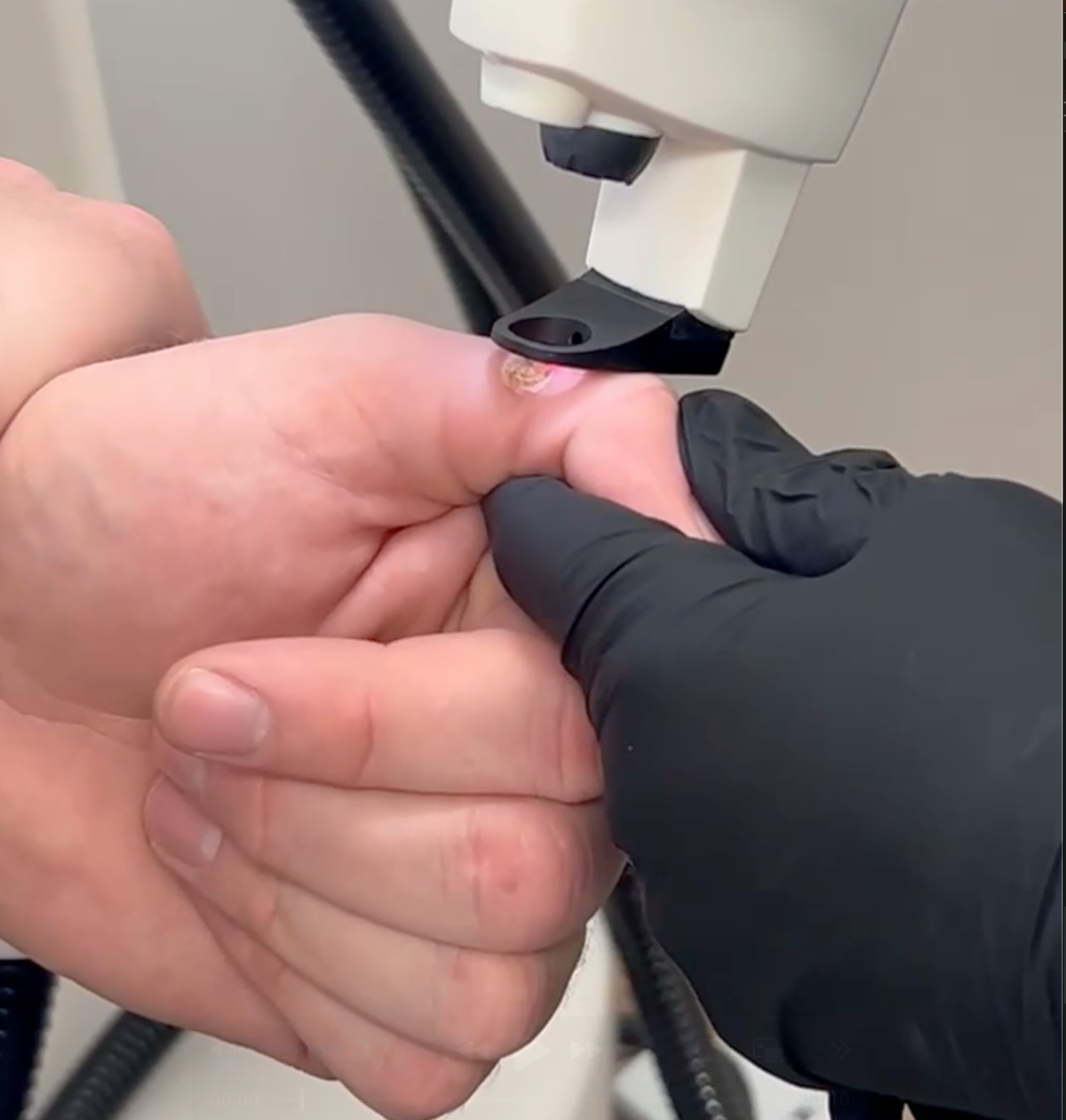 Dr. Sabeen Munib treating a wart on a finger with a laser handpiece, gloved hands, at Spectrum Skin Clinic in Irvine.