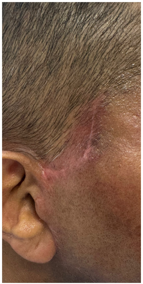 RF Microneedling before — Trauma Scars, Uneven Texture, Hypertrophic Scars, front view