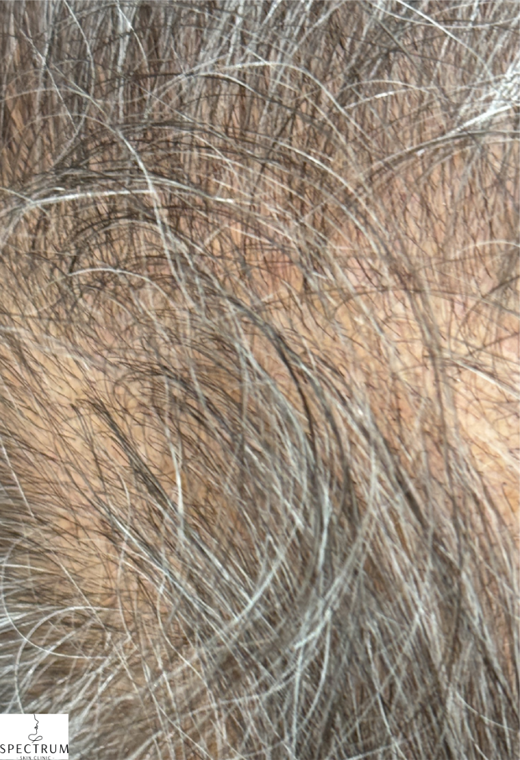 PRFM Hair Therapy after — Hair Thinning at Crown, Vertex Visibility, front view