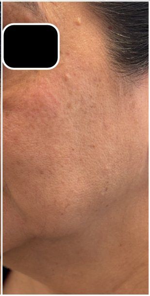 Candela PicoWay, Pico Toning before — Brown Spots, Uneven Skin Tone, Hyperpigmentation, Sun Damage, front view