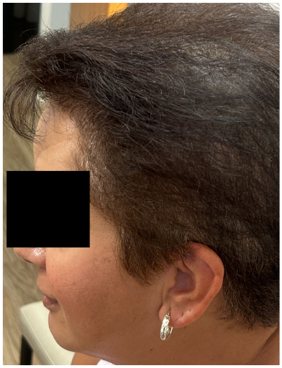 Exosome Hair Therapy before — Hair Thinning, Reduced Hair Density, Visible Scalp Coverage, front view