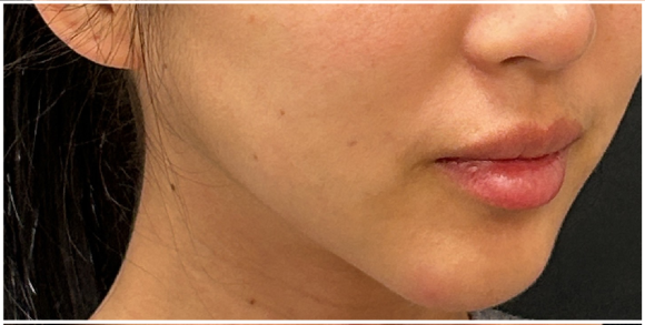 Filler Dissolve before — Filler Migration, Jawline Distortion, Lower Face Heaviness, front view
