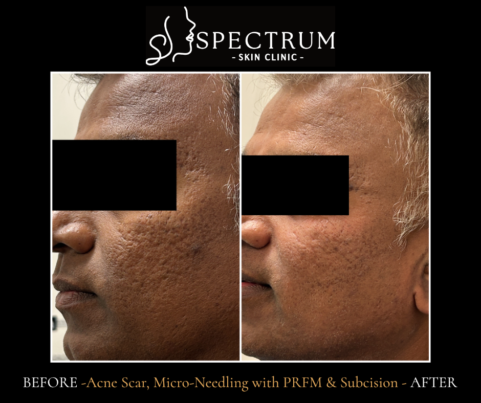 Microneedling with PRFM & Subcision Before & After | Acne Scar Improvement (Side View)