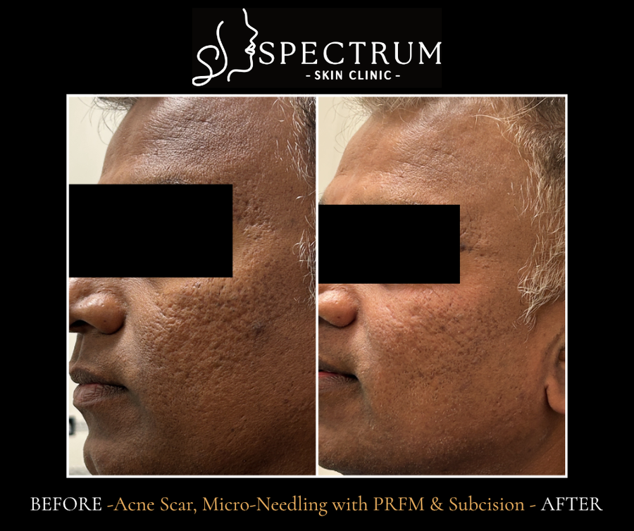 Microneedling with PRFM & Subcision Before & After | Acne Scar Improvement (Side View)