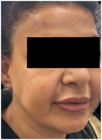 eMatrix Sublative RF Resurfacing before — Sagging and Laxity, Fine Lines and Wrinkles, Loss of Firmness, front view