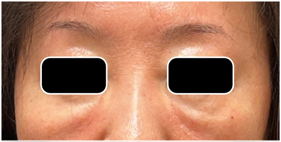 Under Eye Filler Dissolve before — Under Eye Hollows, Filler Migration, Tear Trough Migration, front view