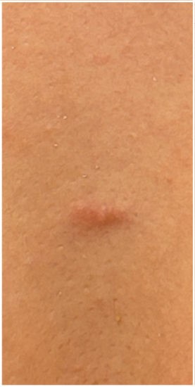 Intralesional Injection for Keloid before — Keloid Scar, Hypertrophic Scarring, front view
